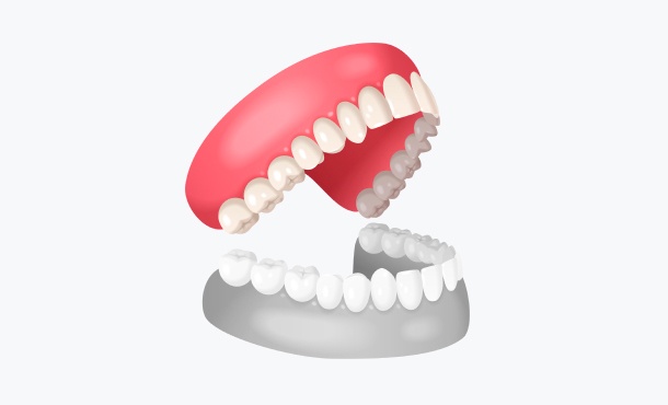 Верхняя челюсть